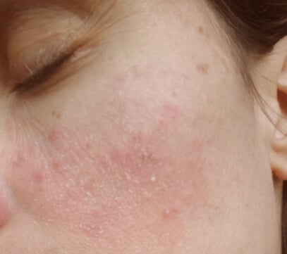 Rosacea - Nach 6 Wochen DemoDerm Anwendung