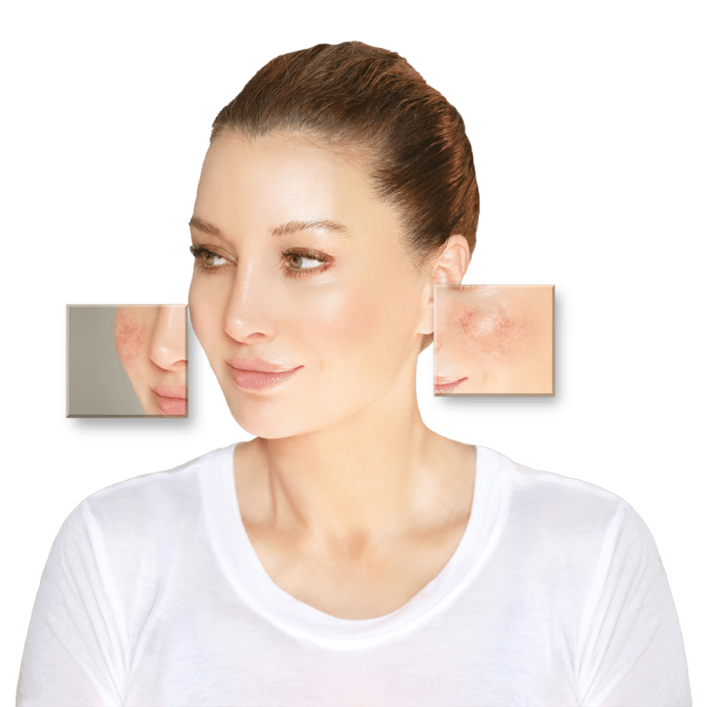 DemoDerm Rosacea Creme als therapieunterstützende Hautpflege