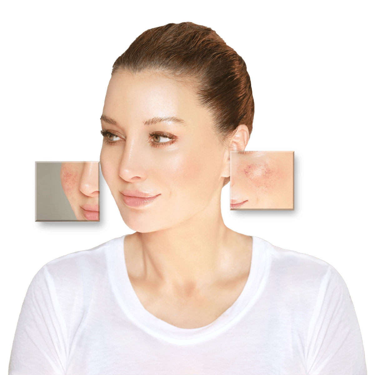 DemoDerm – Rosacea Creme als therapieunterstützende Hautpflege