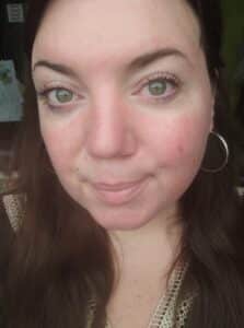 Rosacea Bilder & Fotos - Tanja - Nach 1 Monat Anwendung von DemoDerm