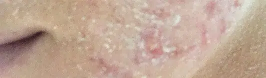 Rosacea und Trockene Haut