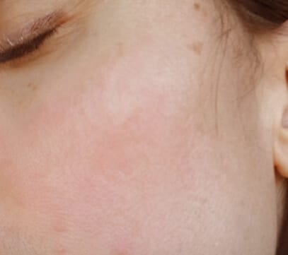 Rosacea - Nach 12 Wochen DemoDerm® Anwendung Rosacea - Nach 12 Wochen DemoDerm Anwendung