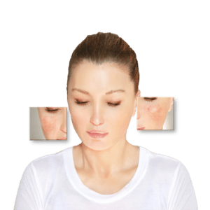 Rosacea Haut - Der DemoDerm 3-Säulen-Plan