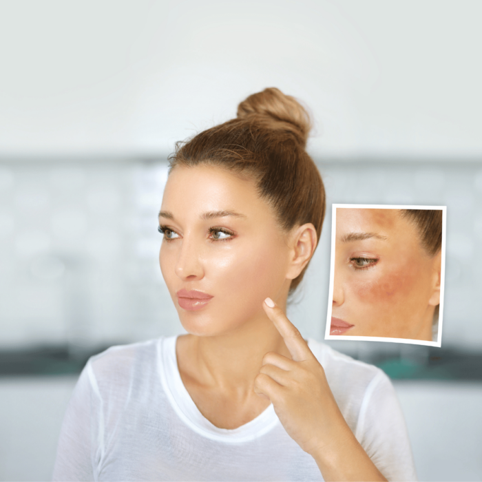 Gesichtspflege bei Rosacea - Die 1. Säule des DemoDerm Hautkonzepts