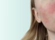 Kein Grund zu erröten: Auslöser für Rosacea Flushs erkennen und vermeiden! - DemoDerm Rosacea Blog
