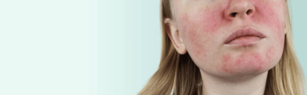Kein Grund zu erröten: Auslöser für Rosacea Flushs erkennen und vermeiden! - DemoDerm Rosacea Blog