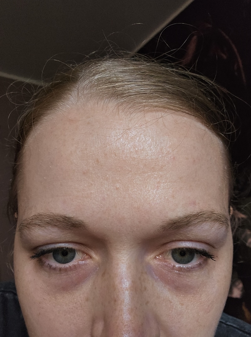 Rosacea Bilder & Fotos - Jenny aus Wien - Nach 6 Monaten Anwendung von DemoDerm