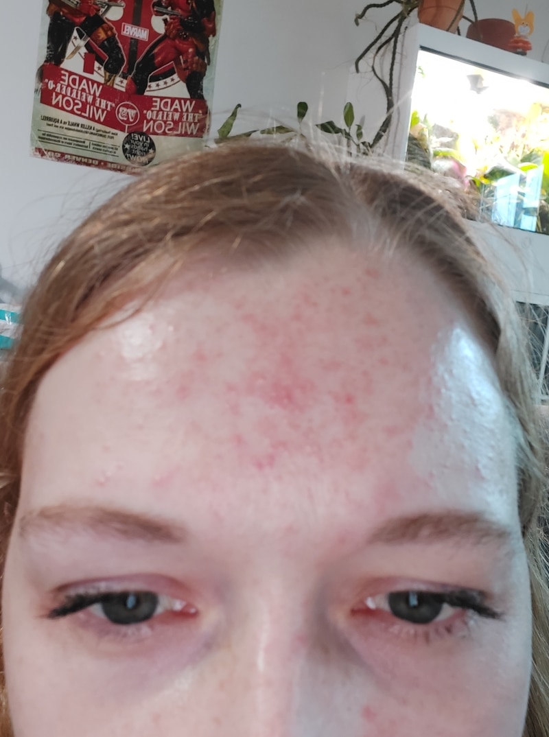 Rosacea Bilder & Fotos - Jenny aus Wien - Vor der Anwendung von DemoDerm