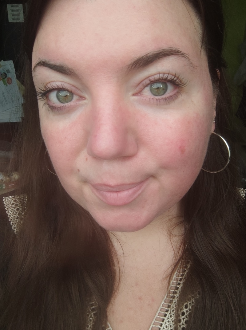 Rosacea Bilder & Fotos - Tanja - Nach 1 Monat Anwendung von DemoDerm