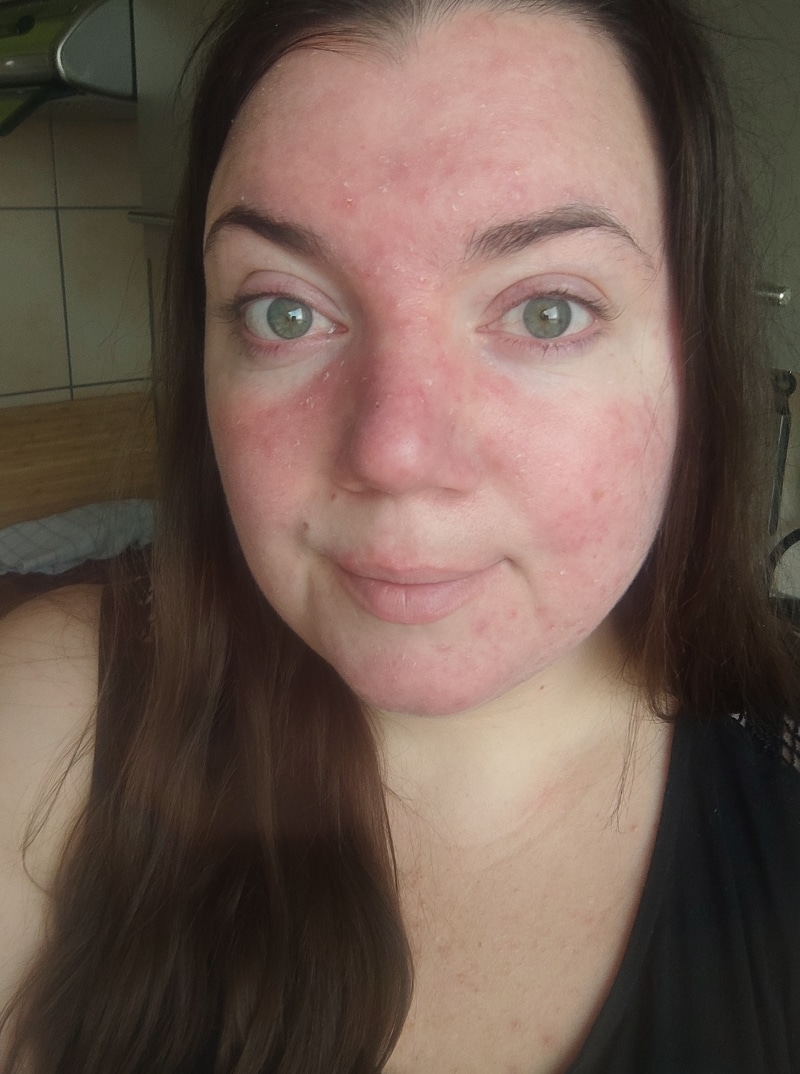 Rosacea Bilder & Fotos - Tanja - Nach 5 Tagen Anwendung von DemoDerm