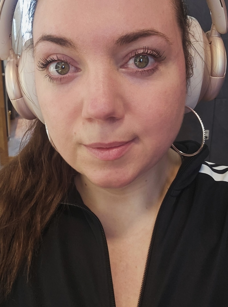 Rosacea Bilder & Fotos - Tanja - Nach 9 Monaten - DemoDerm