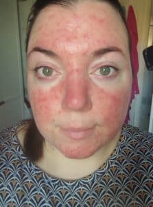 Rosacea Bilder & Fotos - Tanja - Vor der Anwendung von DemoDerm