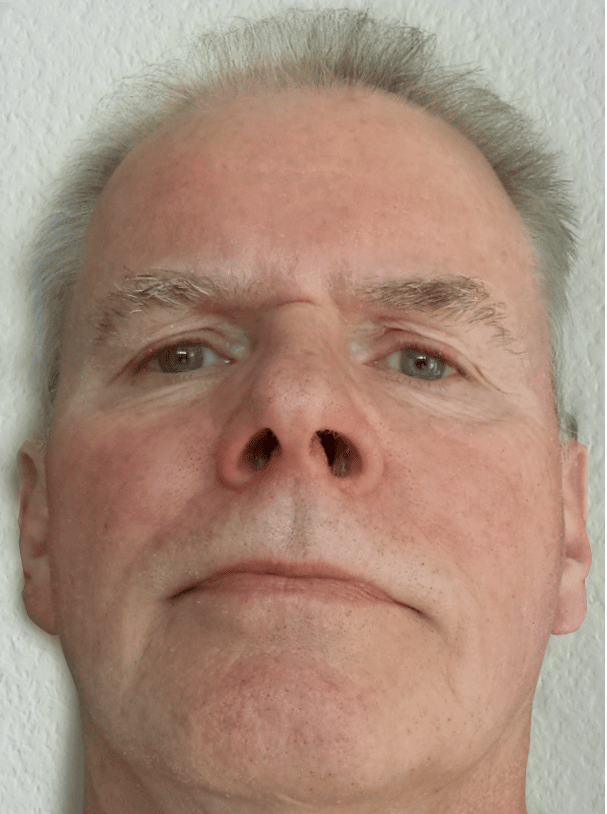 Rosacea Bilder & Fotos - Herr O.S. aus Niedersachsen - Nach vier Wochen Anwendung von DemoDerm