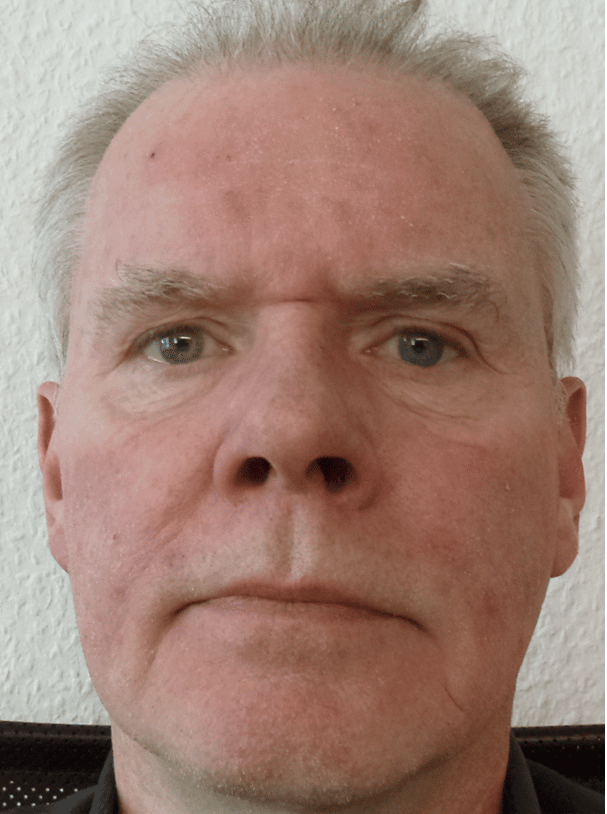 Rosacea Bilder & Fotos - Herr O.S. aus Niedersachsen - Nach zwei Wochen Anwendung von DemoDerm