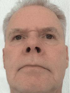 Rosacea Bilder & Fotos - Herr O.S. aus Niedersachsen - Nach 12 Monaten Anwendung von DemoDerm