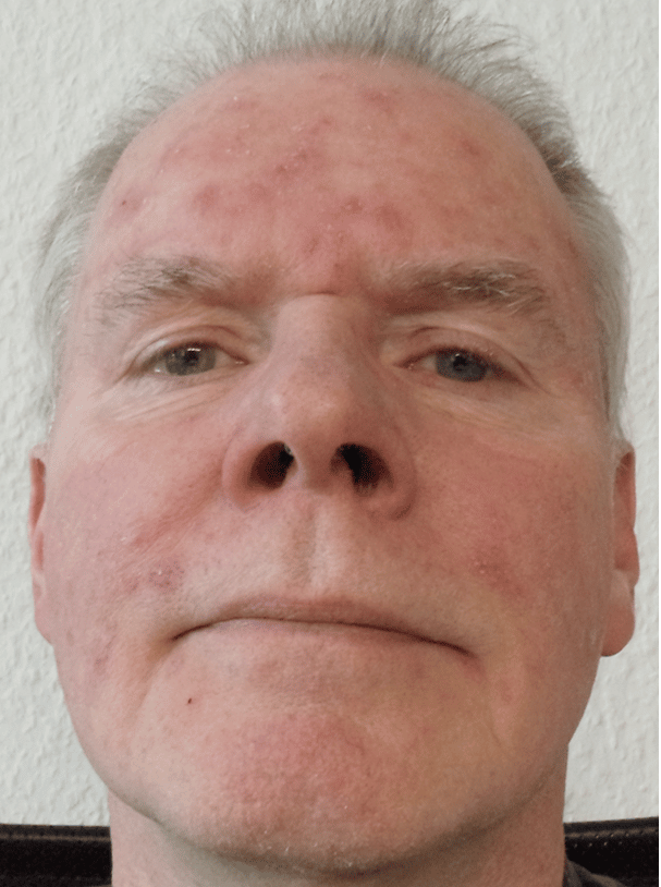 Rosacea Bilder & Fotos - Herr O.S. aus Niedersachsen - Vor der Anwendung von DemoDerm