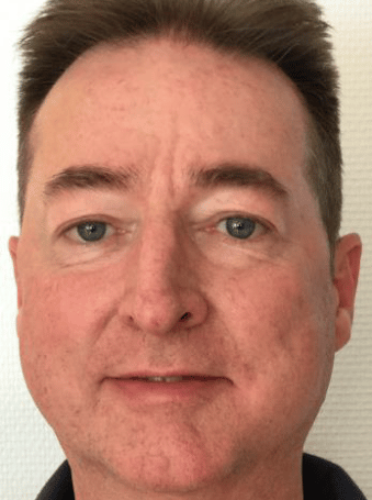 Rosacea Bilder & Fotos - Theo aus Bonn - Nach sechs Wochen Anwendung von DemoDerm