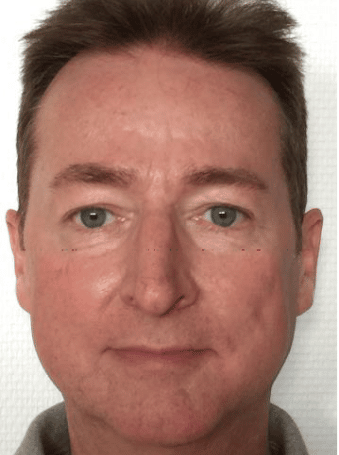 Rosacea Bilder & Fotos - Theo aus Bonn - Nach 12 Monaten Anwendung von DemoDerm