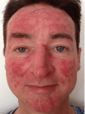 Rosacea Bilder & Fotos - Theo aus Bonn - Vor der Anwendung von DemoDerm